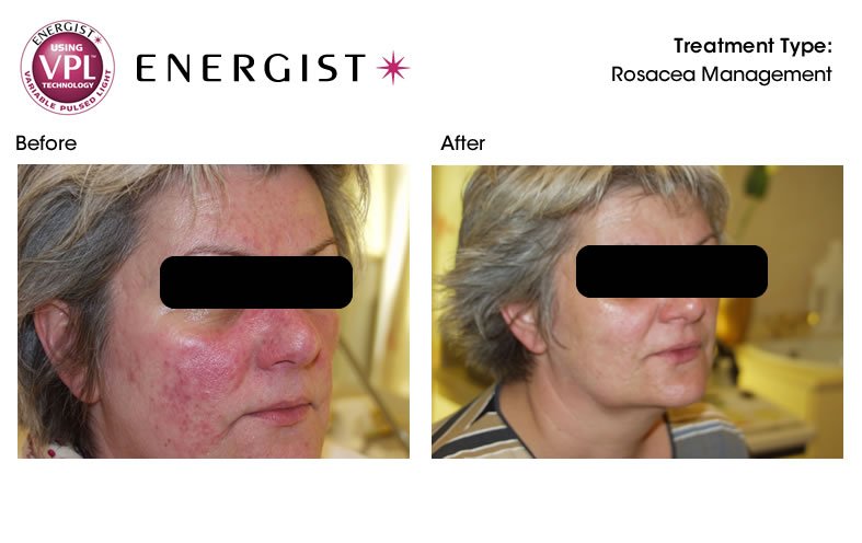 rosacea treatment before after