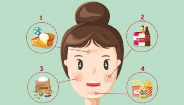 foods-that-cause-acne-beautystorygr