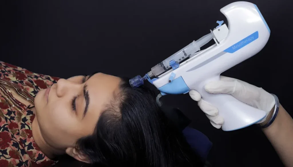 Mesotherapy-For-Hair-Loss-beautystorygr