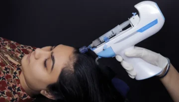 Mesotherapy-For-Hair-Loss-beautystorygr