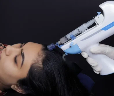 Mesotherapy-For-Hair-Loss-beautystorygr
